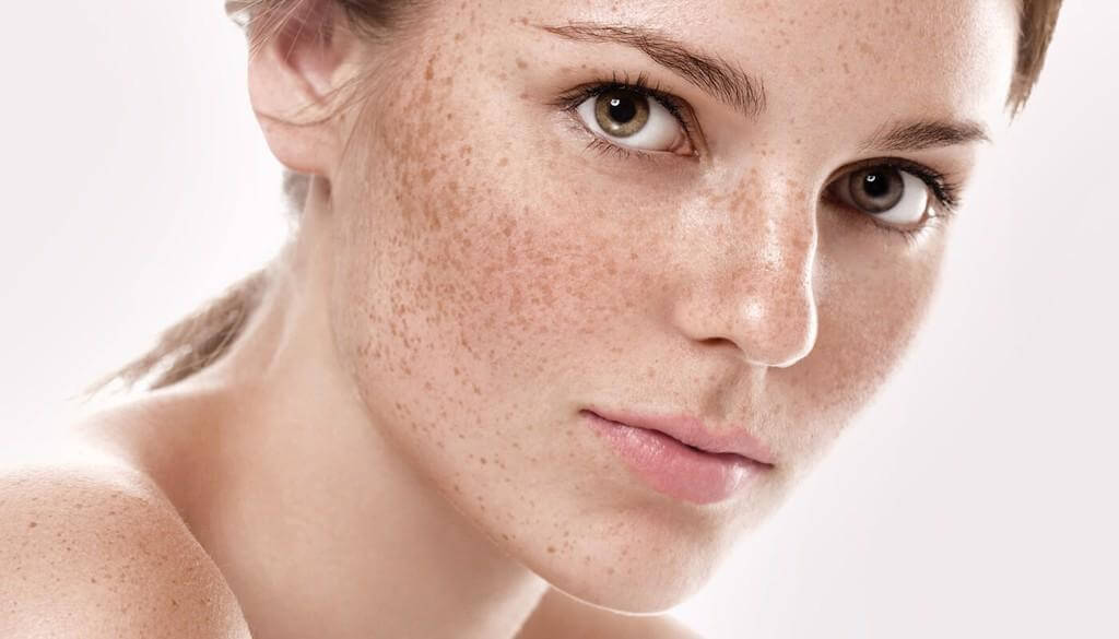 Vấn đề nám da của phụ nữ (Nguồn: Internet)